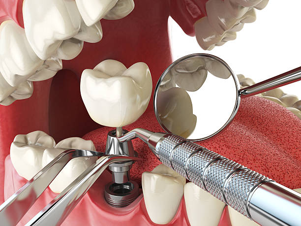 Best Emergency Dentist for Lost Fillings or Crowns in Winlock, WA